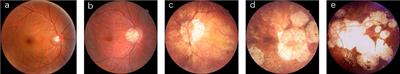 Effective automatic classification methods via deep learning for myopic maculopathy